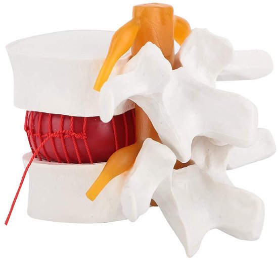 1.5X Medisch Demonstratiemodel van de Lumbale Wervelkolom – Hernia Model met Zachte Elastomeer Tussenwervelschijf, Lichtgewicht Leerhulpmiddel van SOMSO